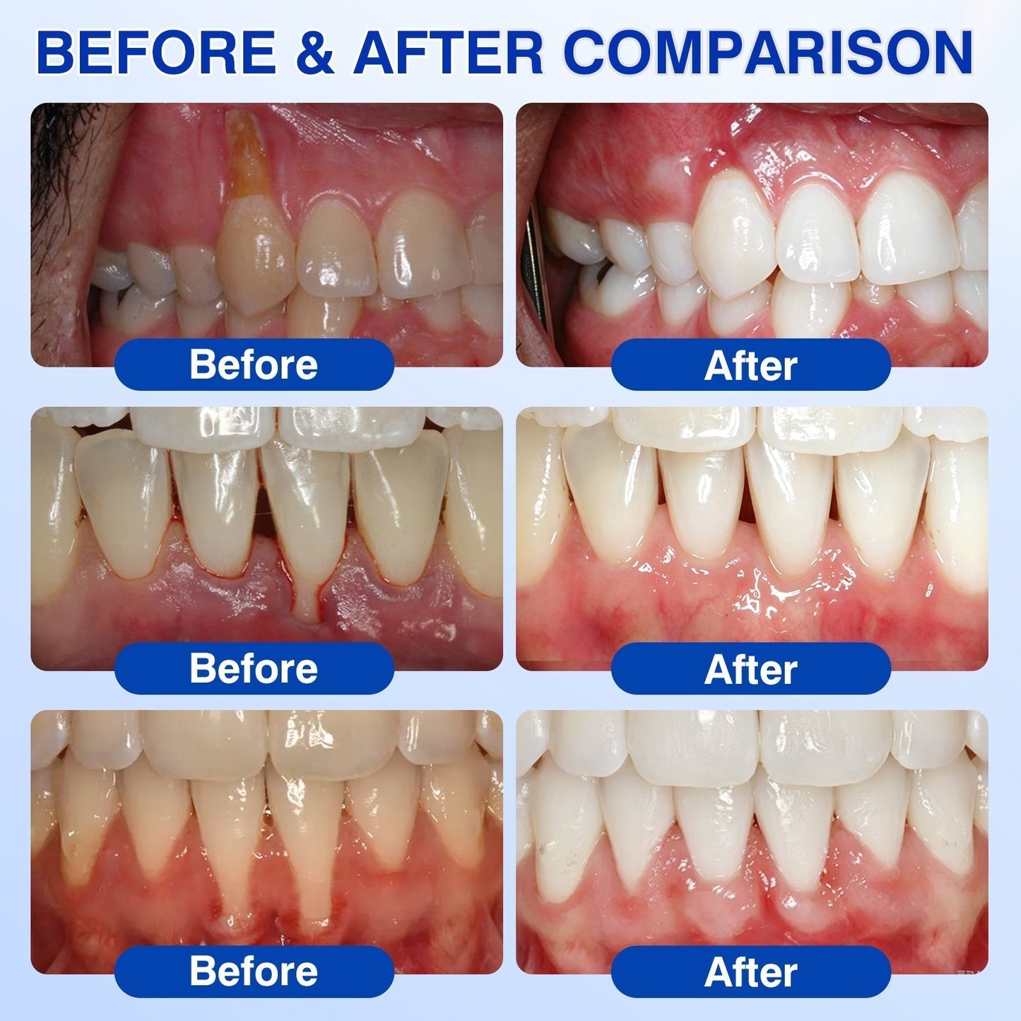 🦷Curalona® GumRevive Periodontal Repair Gel (For Bleeding Gums, Gum Recession & Loose Teeth)