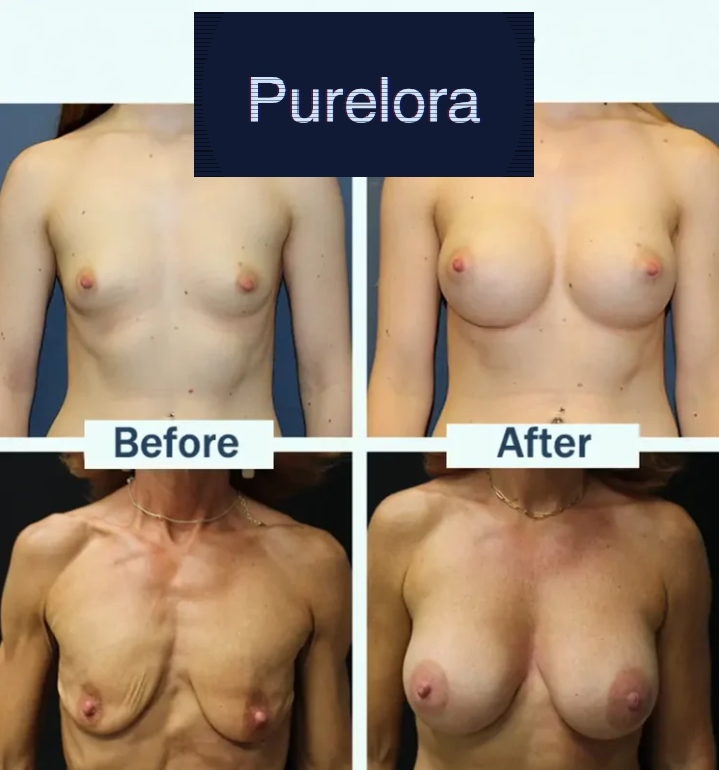 【Official Flagship Store】Purelora® Targeted Breast Enhancement Advanced Nano Microneedle Patch